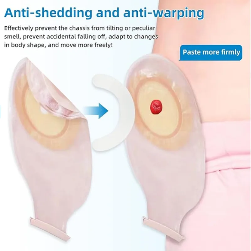 Medical Tape - Medizinischer Stoma-Beutel-Verstärkungsstreifen Elastisches Druckempfindliches Klebeband Spunlace-Band